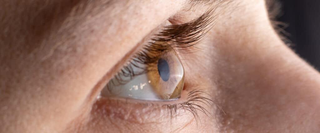 Ojo de un paciente con queratocono.