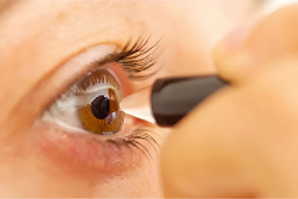 fotografía de una paciente siendo sometida a una paquimetría corneal, se observa el instrumento sobre la córnea de la paciente