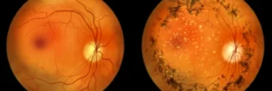 comparativa retinitis pigmentaria, foto de una retina sana, frente a una con retinitis pigmentaria