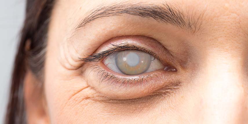 glaucoma